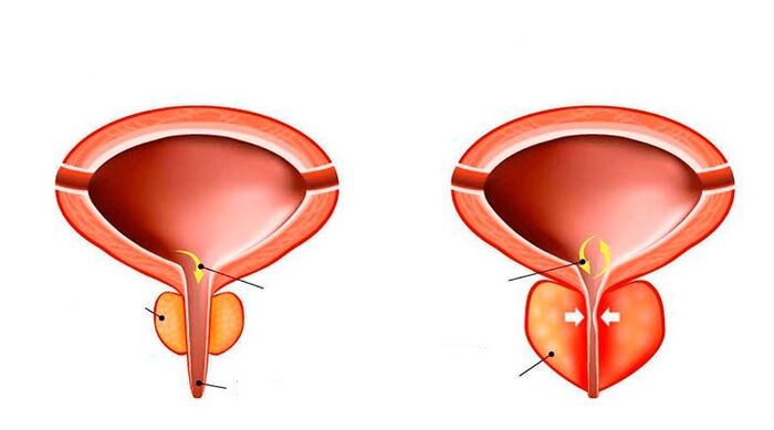 Normalna in vneta prostata