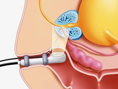 Prebojna biopsija prostate