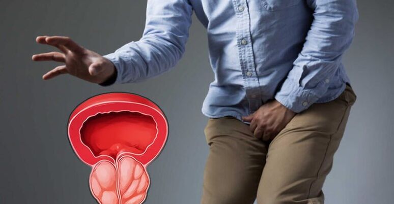 Preprečevanje prostatitisa in adenoma prostate